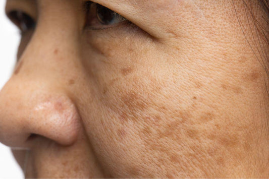 what causes pigmentation, dark spot & uneven in skin tone? - Clinelle