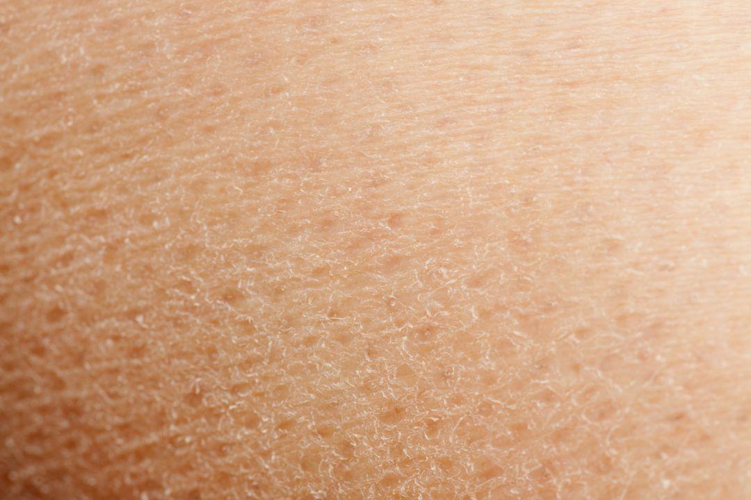 how to get rid of dry skin? - Clinelle