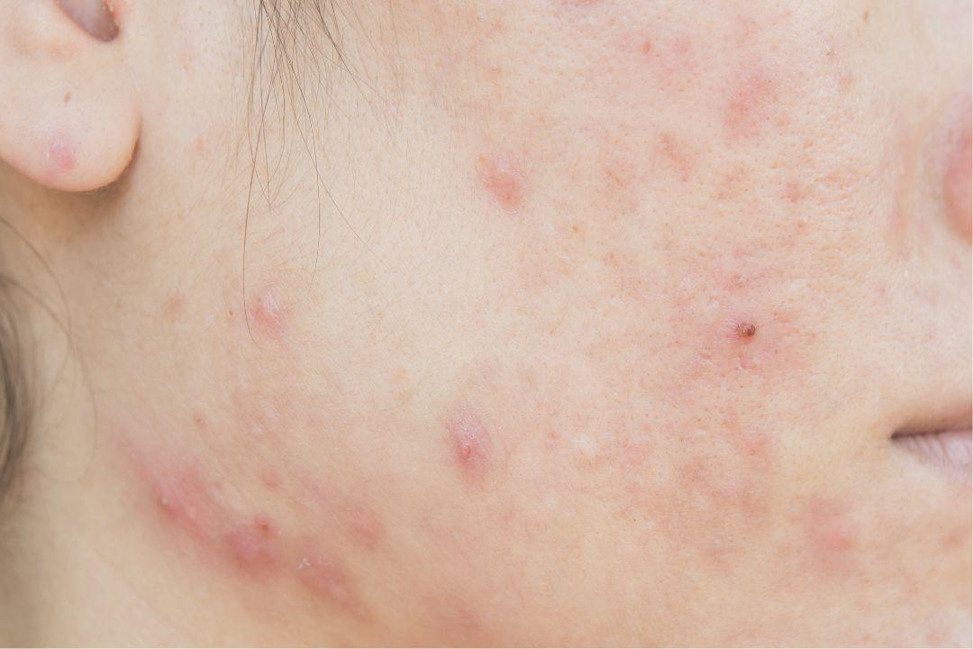 what causes acne? - Clinelle